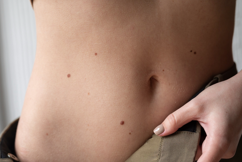 Mole Removal