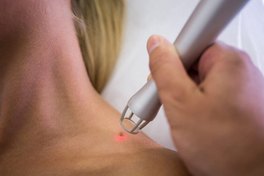 Warts treatment