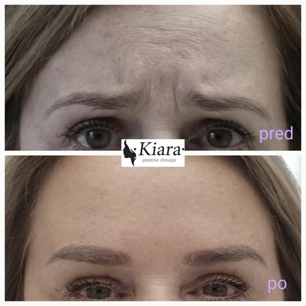 Botox application