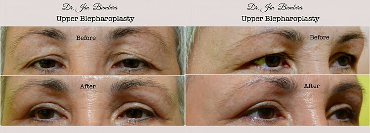 Upper Blepharoplasty