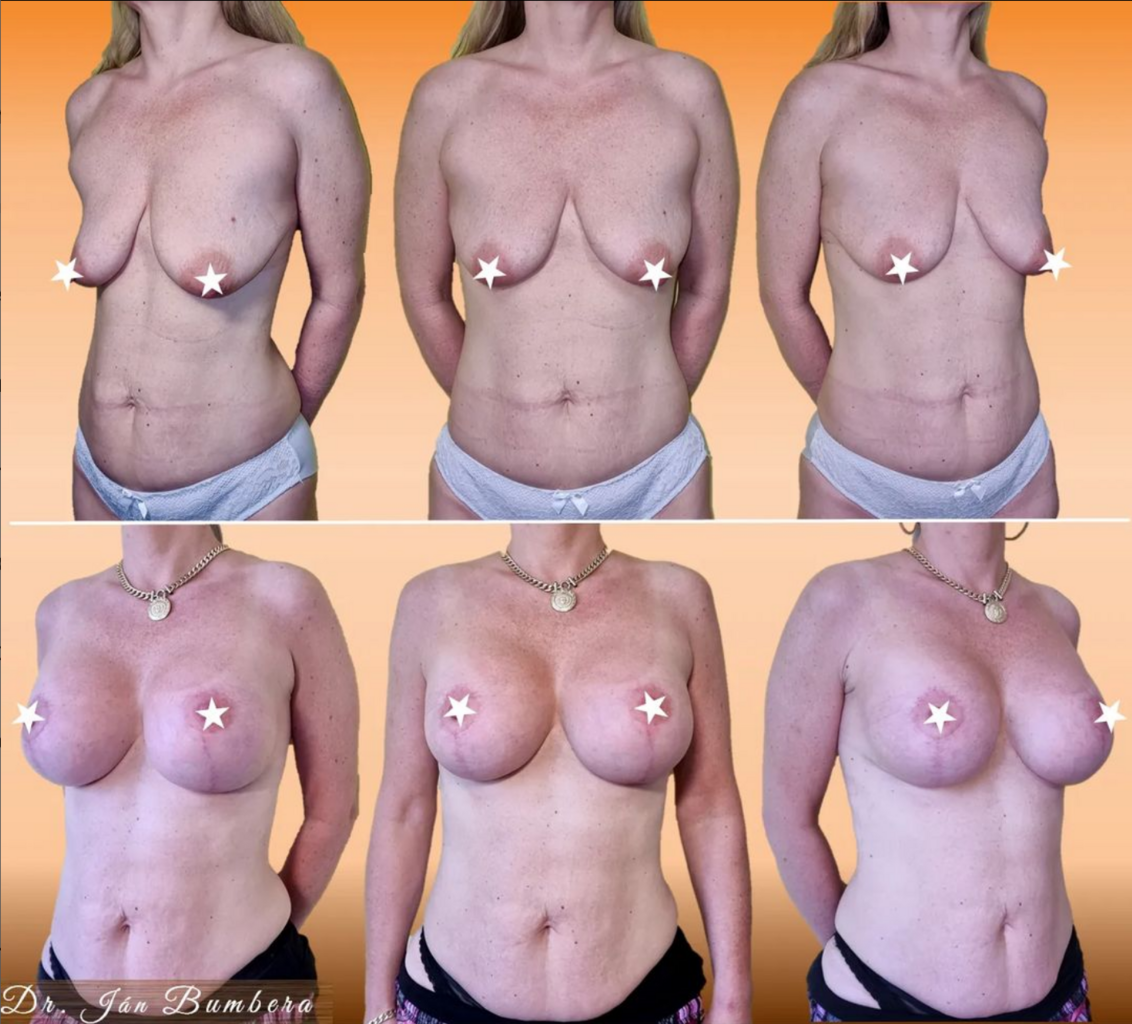 Breast lift and augmentation with implants