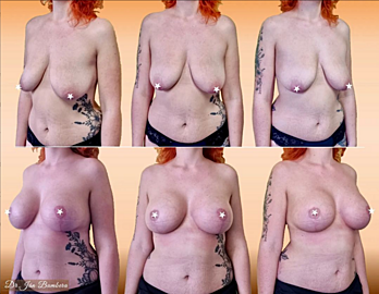 Correction of breast asymmetry and enlargement using implants