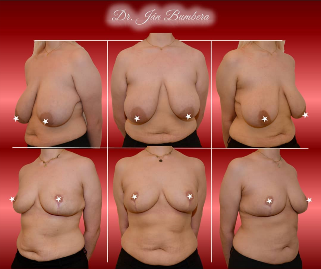 Reduction mammaplasty