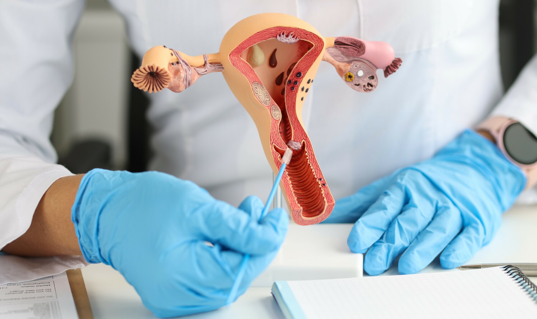 Cone biopsy (Conization of the cervix )