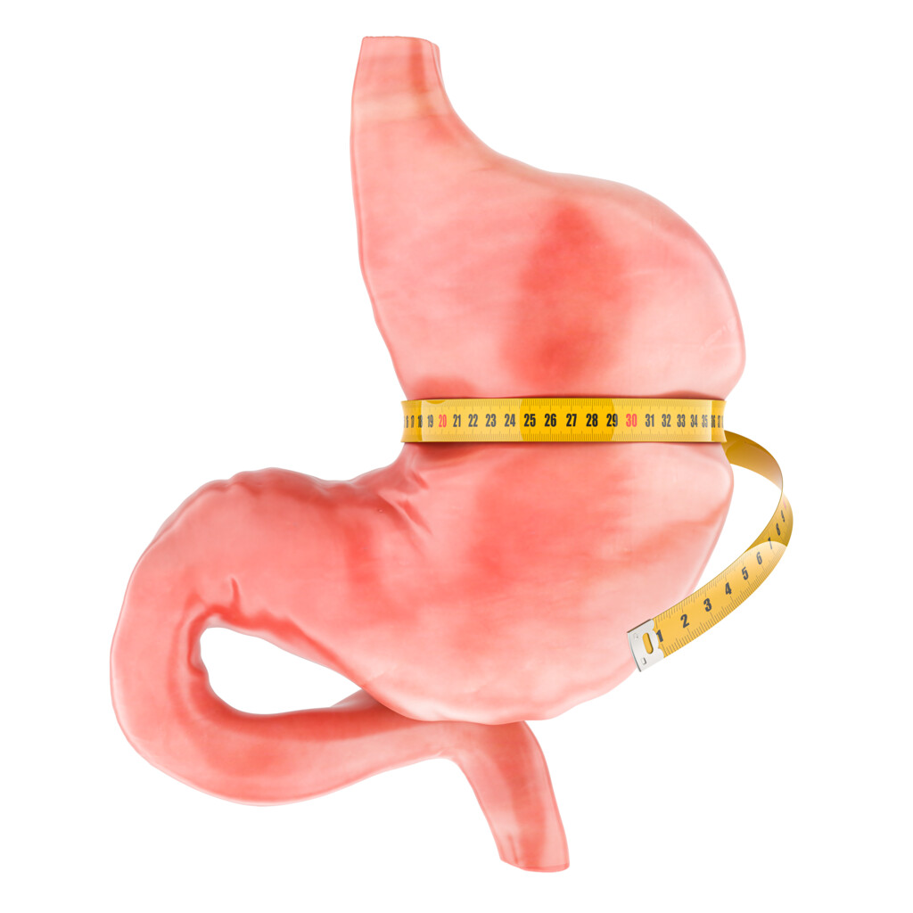 Gastric Reduction (Bariatric Surgery)