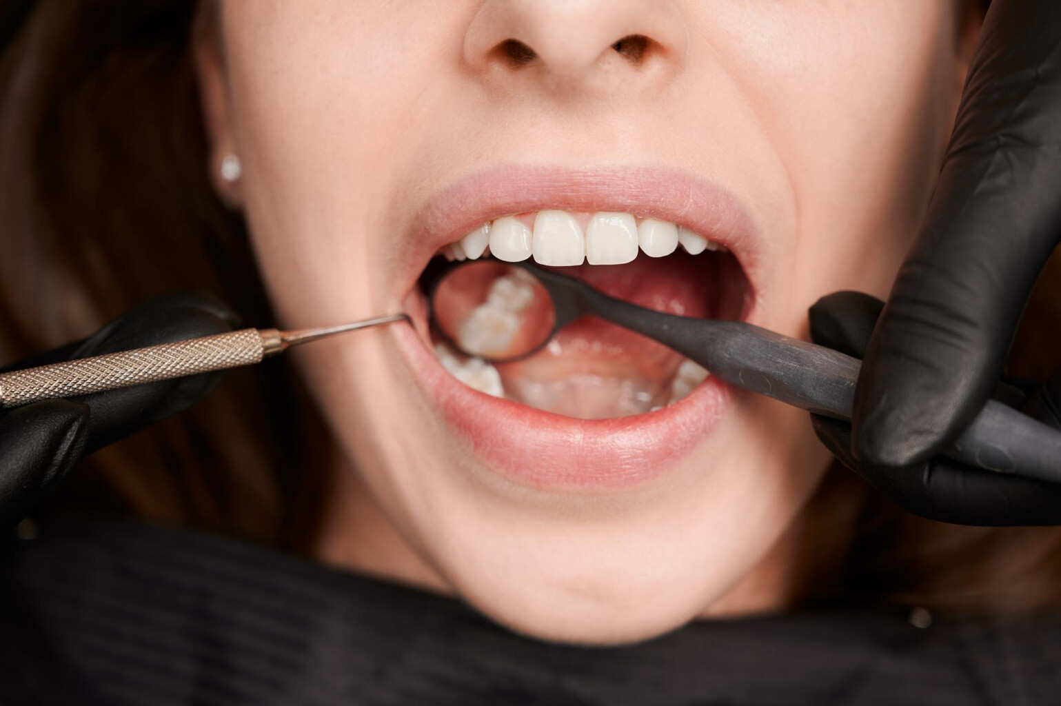 Periodontitis (periodontal disease)